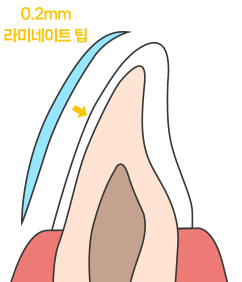 0.2mm 라미네이트 부착