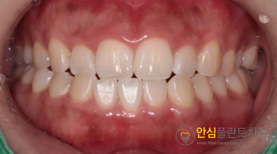 치료 후